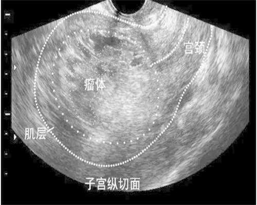 国内代怀机构公司-试管婴儿代孕的具体步骤,
              试管人工周期移植方案