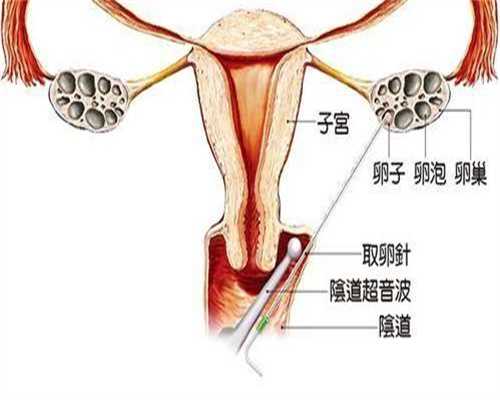 做试管是窦卵泡还是卵泡，做试管是窦卵泡还是卵泡好