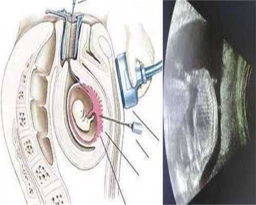 2026年去泰国私立医院做助孕代怀生子价格