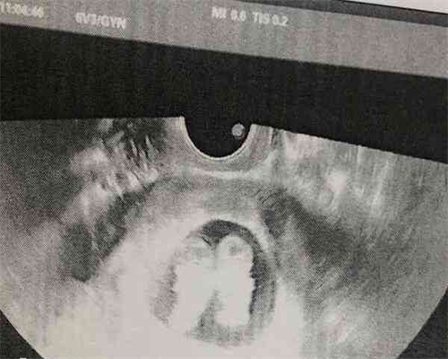 试管婴儿取卵用什么工具