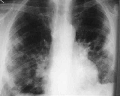 包生儿子多少钱,AMH值0.23卵巢早衰能做试管婴儿吗？附明细!！